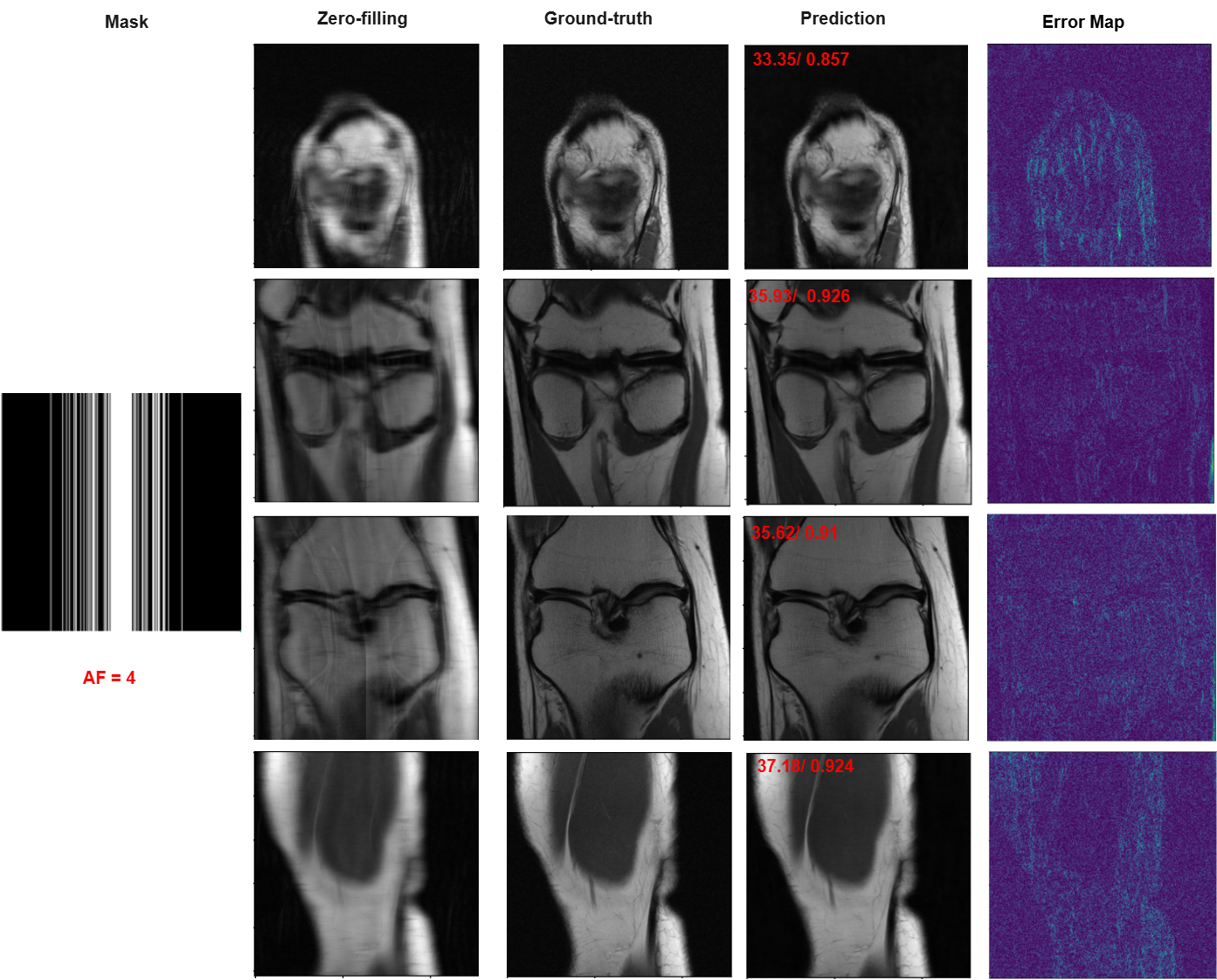 Reconstructed knee images (x4 Acceleration)