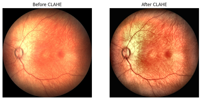 Clahe Image Processing